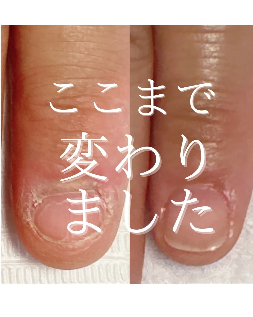 【その深爪、変わります】